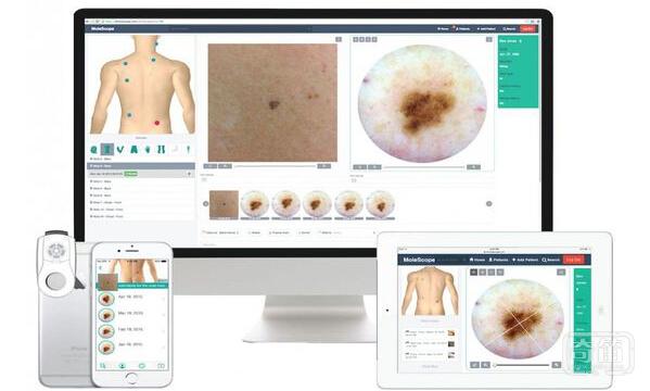 MoleScope智能镜头能完成皮肤癌的自我检测